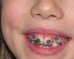 Maddy Braces